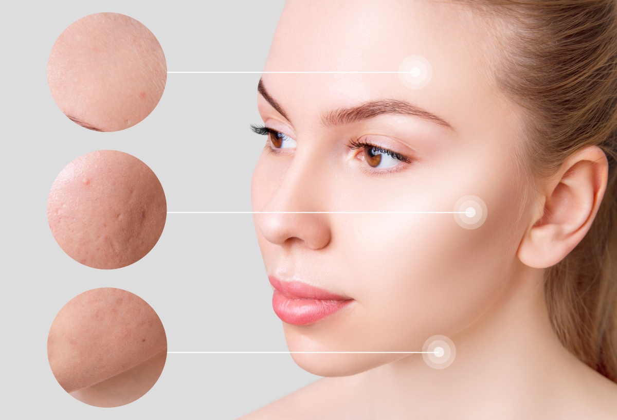 виды постакне